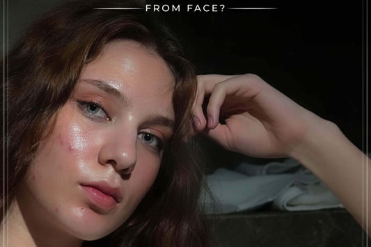 How Do I Remove Pimples from My Face?