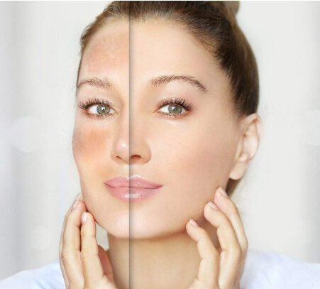 How to Reduce Dark Spots on Face